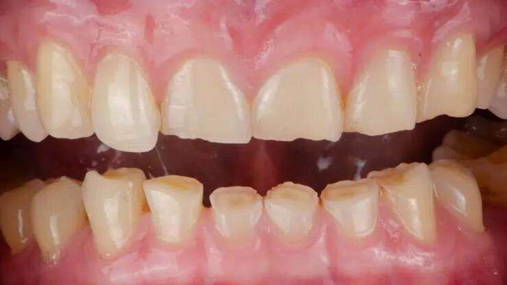 A photo of worn teeth due to grinding