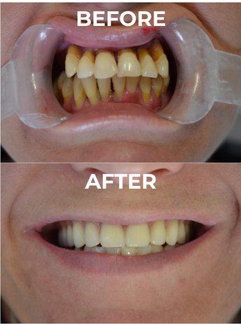 A photo of before and after upper full denture
