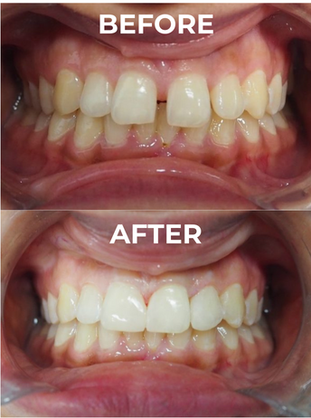 A photo of before and after composite veneers