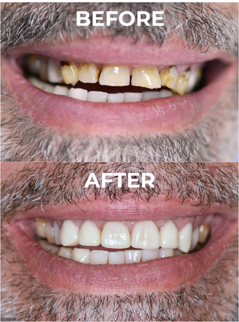 An image of before and after crowns front