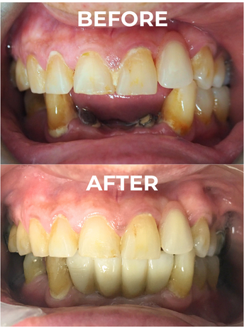 An image of before and after implant crowns