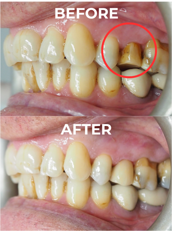 An image of before and after crown