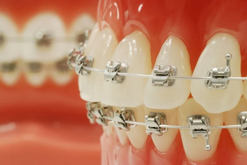 An image of braces